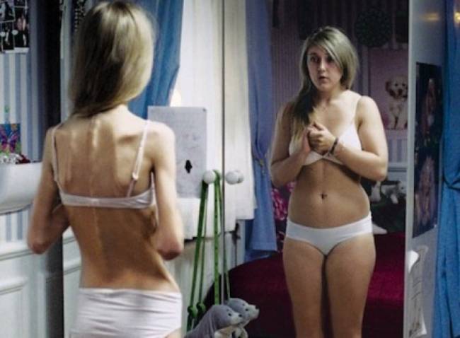 anoressia immagine distorta